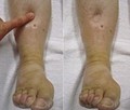 picture of edema pitting